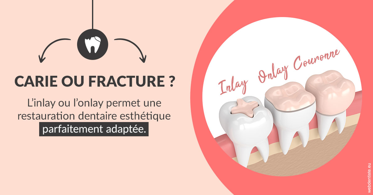 https://scp-cuenca-grocq-slonim-montoux.chirurgiens-dentistes.fr/T2 2023 - Carie ou fracture 2
