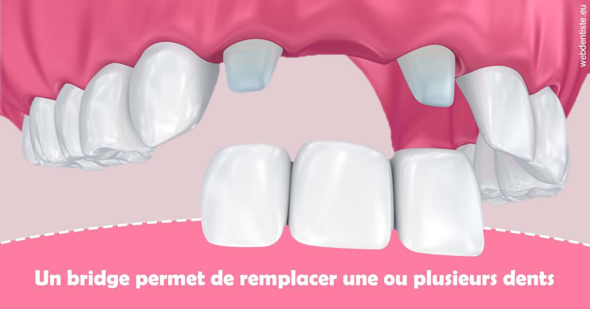 https://scp-cuenca-grocq-slonim-montoux.chirurgiens-dentistes.fr/Bridge remplacer dents 2