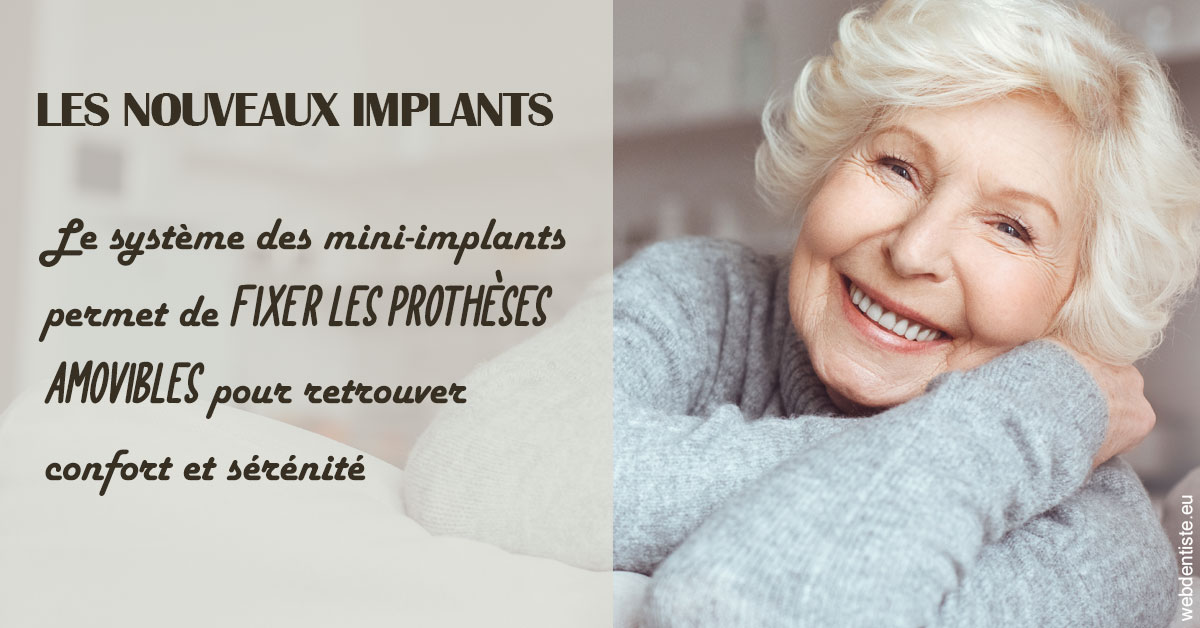 https://scp-cuenca-grocq-slonim-montoux.chirurgiens-dentistes.fr/Les nouveaux implants 1