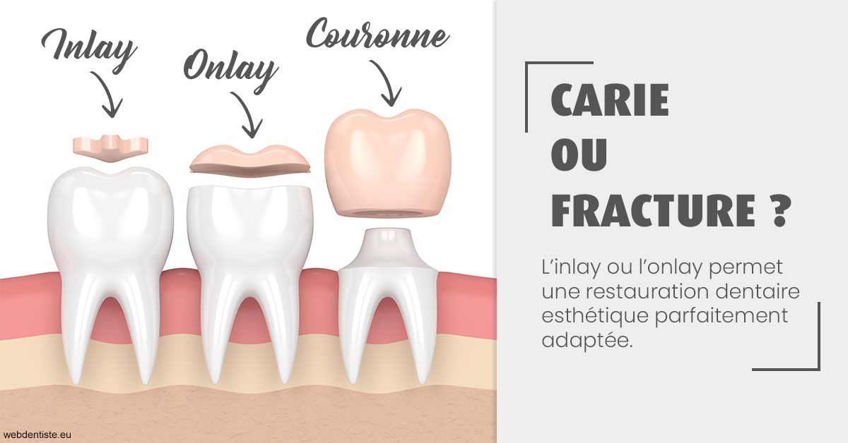 https://scp-cuenca-grocq-slonim-montoux.chirurgiens-dentistes.fr/T2 2023 - Carie ou fracture 1