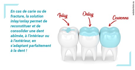 https://scp-cuenca-grocq-slonim-montoux.chirurgiens-dentistes.fr/L'INLAY ou l'ONLAY