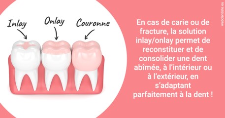 https://scp-cuenca-grocq-slonim-montoux.chirurgiens-dentistes.fr/L'INLAY ou l'ONLAY 2