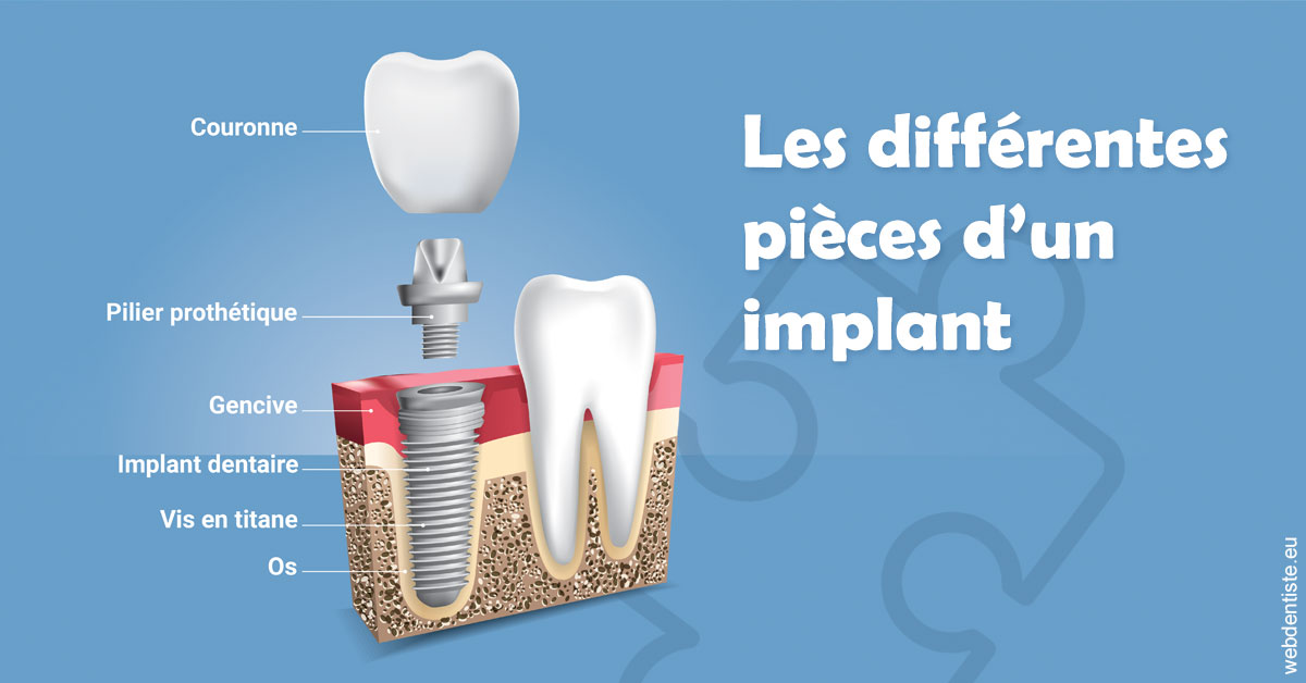 https://scp-cuenca-grocq-slonim-montoux.chirurgiens-dentistes.fr/Les différentes pièces d’un implant 1